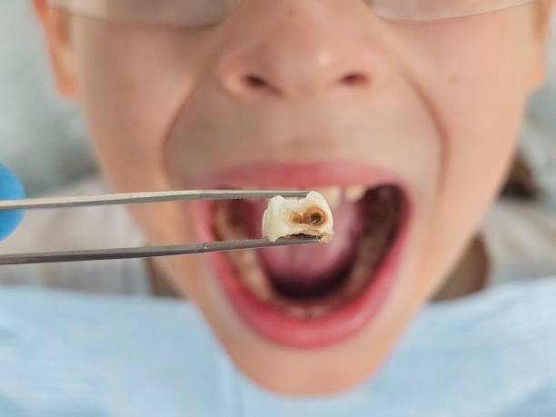 Best Emergency Tooth Extraction in Twinsburg, OH
